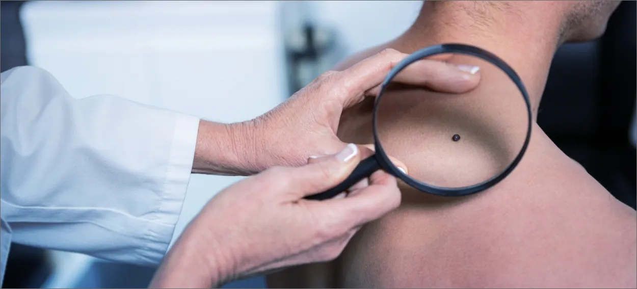 Alunițele. Când ne alarmăm și care sunt riscurile expunerii la soare? – Sfatul specialiștilor